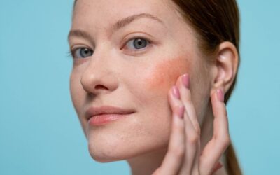 What Causes Skin Redness After Weather Changes?