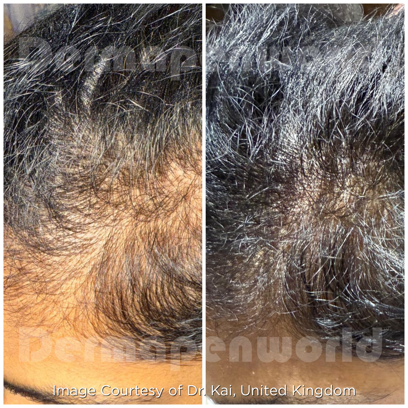 EXO-GROW real client hair progress